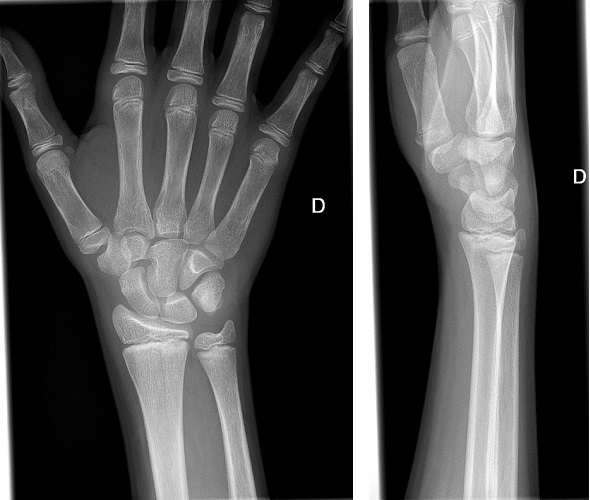 Figura 1. Rx de muñeca derecha 2.º episodio artritis. Irregularidad en la epífisis cubital (informada como imagen dudosa de fractura), solo visualizada en proyección anteroposterior.