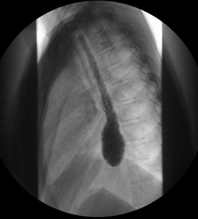 Figura 1. Esofagograma con contraste: dilatación del bolsón distal esofágico con retención de alimentos. No hay paso de contraste a través de la unión esofagogástrica