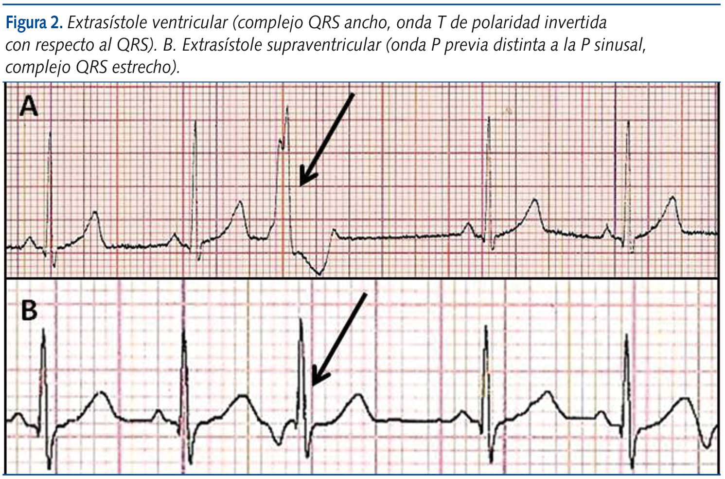 Figura 2. Extrasístole ventricular (complejo QRS ancho, onda T de polaridad invertida con respecto al QRS). B. Extrasístole supraventricular (onda P previa distinta a la P sinusal, complejo QRS estrecho).