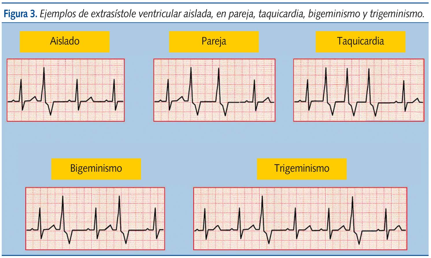 Figura 3. Ejemplos de extrasístole ventricular aislada, en pareja, taquicardia, bigeminismo y trigeminismo.