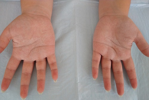 Figura 1. Placas blanquecinas en las palmas de las manos de aspecto macerado