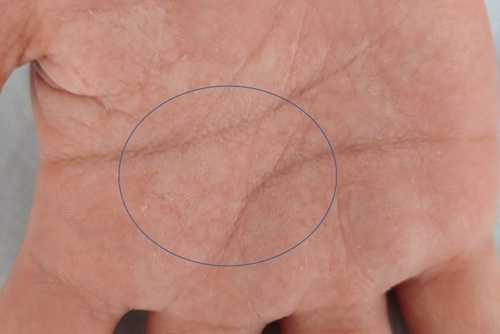 Figura 2. Con más detalle, se aprecian orificios puntiformes en la superficie palmar