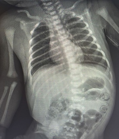 Figura 1. Neumoperitoneo por perforación intestinal.