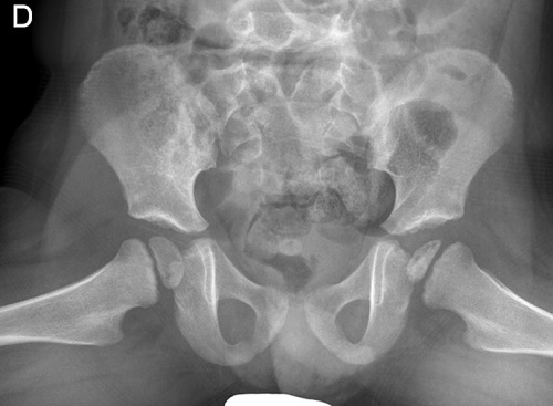 Figura 2. Cadera axial. Imagen en cáscara de huevo en cadera izquierda.