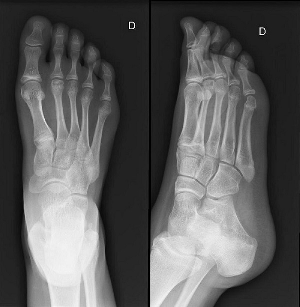 Figura 1. Radiografía simple del tobillo-pie (anteroposterior y lateral), donde se confirma la presencia de una patología de origen mecánico, sito en el segundo metatarsiano: enfermedad de Freiberg (o Kohler II).
