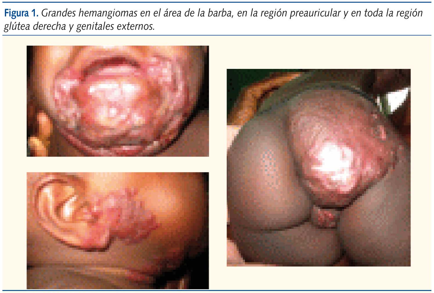 Figura 1. Grandes hemangiomas en el área de la barba, en la región preauricular y en toda la región glútea derecha y genitales externos.