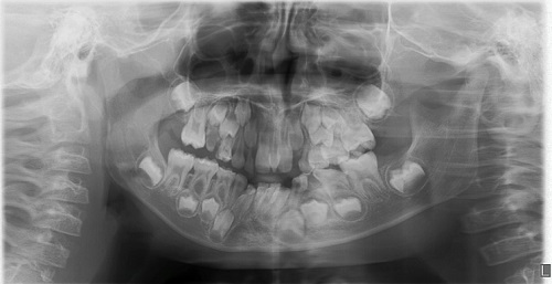 Figura 2. Ortopantografía. Se observa un único diente supernumerario en posición vertical situado en palatino en relación con el tercio apical de la raíz del 21. No se observan otros supernumerarios, no hay agenesias y se observan múltiples caries en dentición temporal