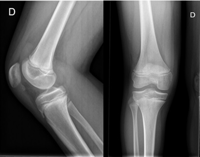 Figura 1. Radiografía anteroposterior y lateral de rodilla con avulsión desplazada del polo inferior de la patela de consistencia cartilaginosa, orientándose como fractura tipo sleeve.