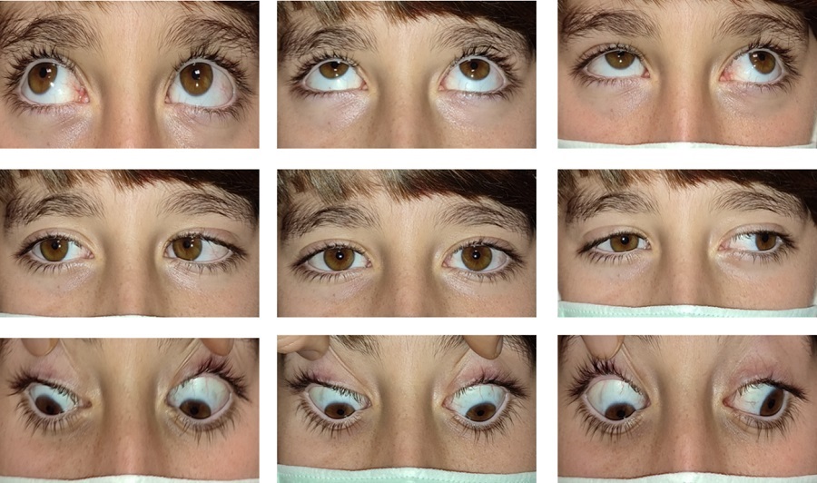 Figura 1. Exploración ocular donde se observa ortotropia en posición primaria, junto con limitación a la abducción de OD, limitación a la aducción de OD y cierre de la hendidura palpebral, hallazgos compatibles con síndrome de Duane tipo III.