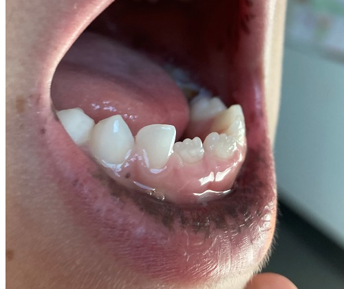 Figura 1. Síndrome de Peutz-Jeghers: hiperpigmentación oral en paciente de 5 años