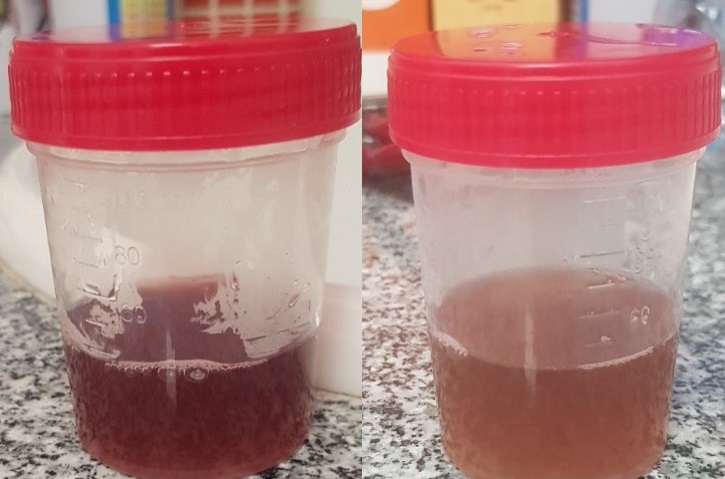 Figura 1. Izquierda: hematuria macroscópica del primer día. Derecha: orina color té, correspondiente al día +9 de evolución.