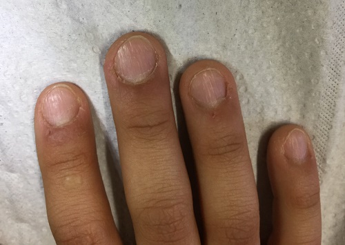 Figura 1. Imagen de la apariencia de las uñas de las manos del paciente