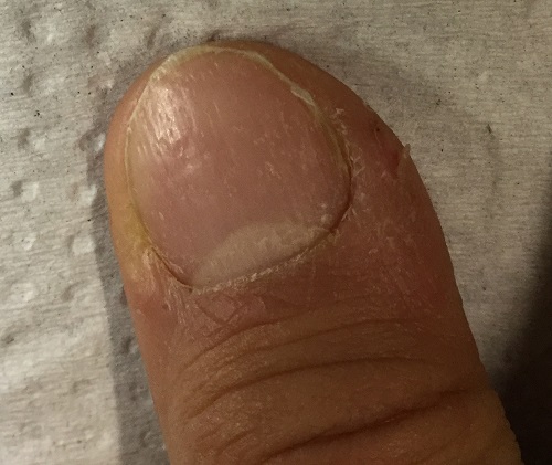 Figura 2. Imagen de uña del primer dedo, en la que se aprecia la uña deslustrada, con surcos longitudinales y pitting