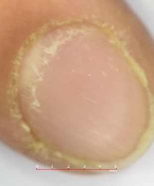 Figura 3. Imagen de la uña tras tratamiento tópico corticoideo