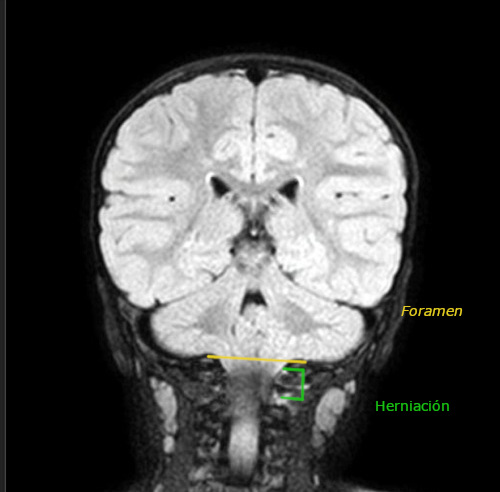 Figura 2. Corte coronal de resonancia magnética nuclear donde se objetiva herniación de amígdalas cerebelosas