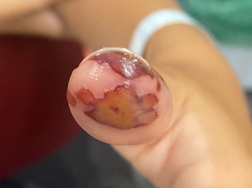 Figura 1. Inflamación en matriz ungueal del primer dedo de la mano izquierda, con contenido purulento y lesión violácea