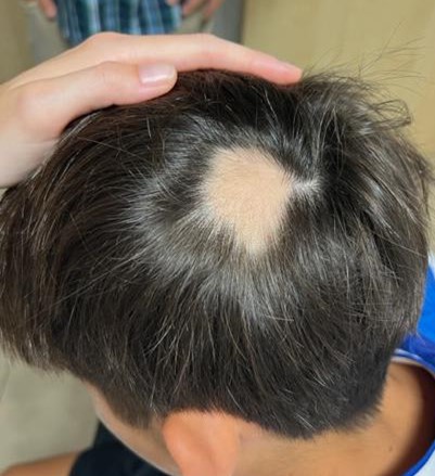 Figura 1. Alopecia localizada, con bordes irregulares y pelos de diferentes longitudes en zona occipital derecha 
