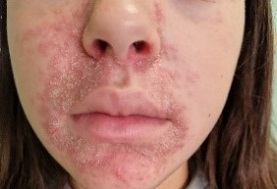 Figura 1. Dermatitis periorificial en la zona facial