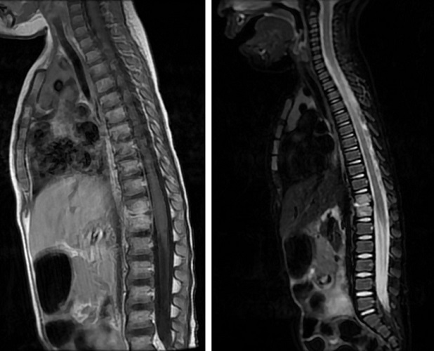 Figura 1. Resonancia magnética: espondilodiscitis aguda en D11-D12 con afectación del disco