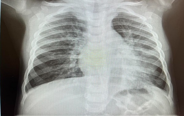 Figura 1. Bronconeumonía bilateral