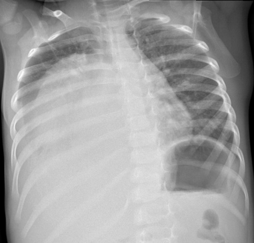 Figura 1. Radiografía de tórax, en la que se objetiva una gran masa torácica con desplazamiento de estructuras y derrame pleural asociado