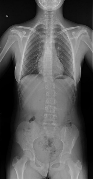 Figura 3. Radiografía en la que se aprecia escoliosis secundaria tras la segunda intervención quirúrgica
