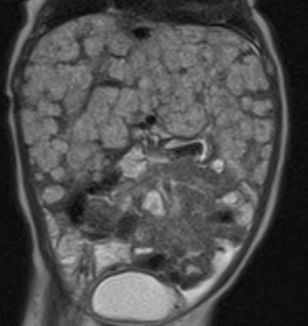 Figura 2. Resonancia magnética. Hemangiomatosis infantil hepática difusa