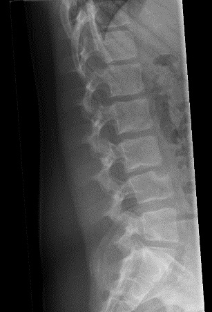 Figura 1. Radiografía lateral de columna vertebral en la que se aprecia lesión osteolítica con margen escleroso ubicada en el ángulo anterosuperior del cuerpo vertebral de L4, con espacio discal discretamente disminuido