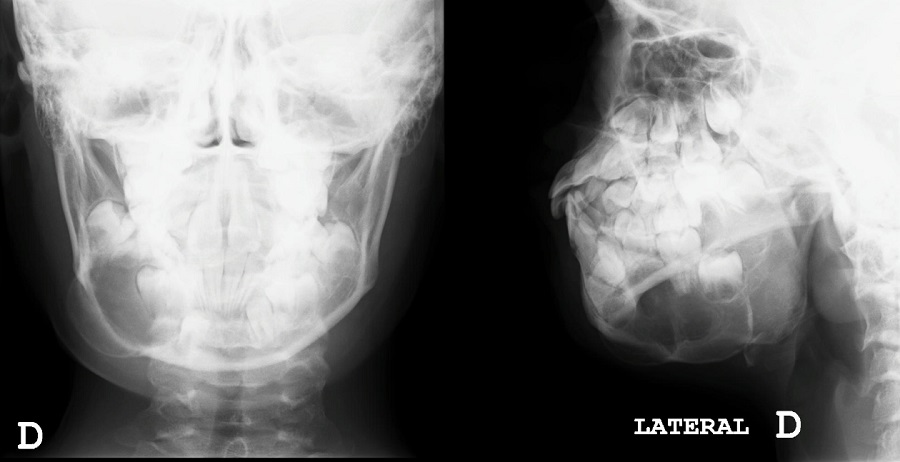Figura 1. Radiografía anteroposterior y lateral