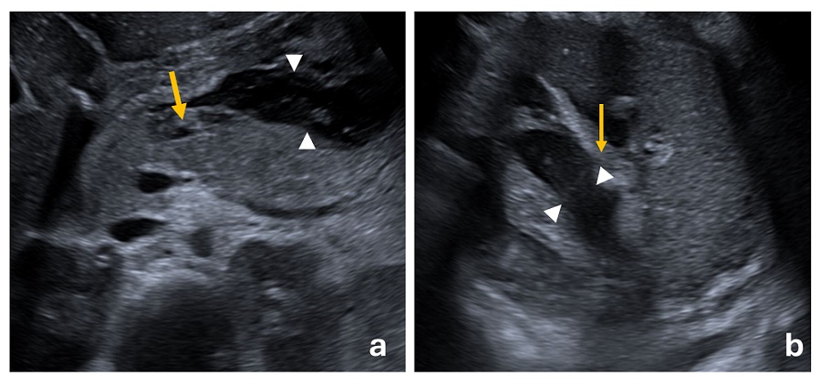 Figura 1. (a) Imagen axial de ecografía abdominal en la cual visualizamos la glándula pancreática aumentada de tamaño con áreas de ecogenicidad heterogénea en cuello-cuerpo pancreático (flecha amarilla) con líquido libre en espacio retroperitoneal, ecogénico y heterogéneo, sin delimitarse una clara pared (Δ). (b) Imagen axial de ecografía abdominal que muestra cambios inflamatorios en la grasa adyacente a la cola pancreática (flecha amarilla) y presencia de líquido libre no coleccionado en dicha localización (Δ).