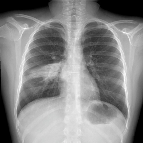 Figura 1. Radiografía del tórax con infiltrado en lóbulo medio derecho sin derrame asociado