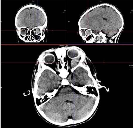 Figura 1. TAC sin contraste: cortes axial, sagital y frontal