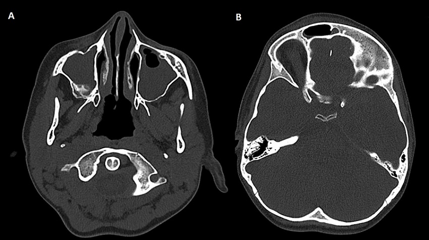 Figura 3. (A) Pansinusitis. Se observan senos maxilares ocupados. (B) Edema frontal (tumor inflamatorio de Pott)