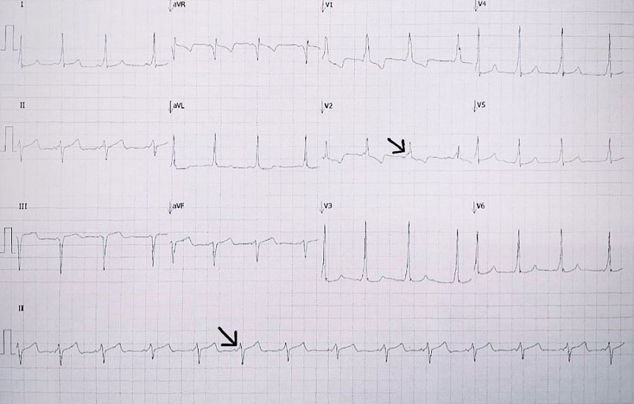 Figura 1. Síndrome de Wolff-Parkinson-White. Las flechas señalan ondas delta de preexitación ventricular