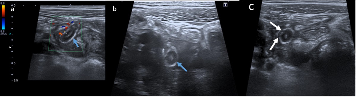 Hallazgos ecográficos compatibles con apendicitis del muñón complicada: (a y b) estructura tubular con ecoestructura en capas compatible con muñón apendicular en planos axial y longitudinal (flechas azules). Presenta aumento de calibre (10 mm), engrosamiento de la capa submucosa (hiperecogénica), e hiperemia parietal vista en (a) como aumento de la señal Doppler; (c) discontinuidades en la capa submucosa compatibles con microperforaciones (flechas blancas)