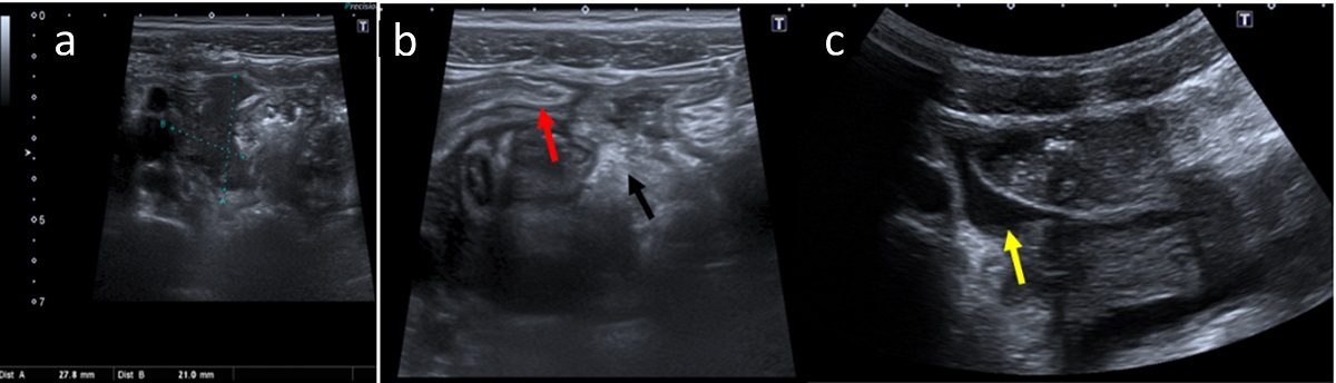 Figura 2. Hallazgos ecográficos compatibles con apendicitis del muñón complicada: (a) colección adyacente al muñón apendicular de ecogenicidad heterogénea; (b) cambios inflamatorios locorregionales visualizados como un aumento de la ecogenicidad de la grasa periapendicular (flecha negra) y engrosamiento parietal del íleon terminal (flecha roja); (c) pequeña cantidad de líquido libre anecoico entre asas (flecha amarilla). 