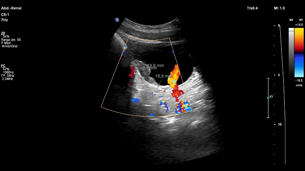 Figura 2. Imagen ecográfica compatible con esquistosomiasis urinaria crónica