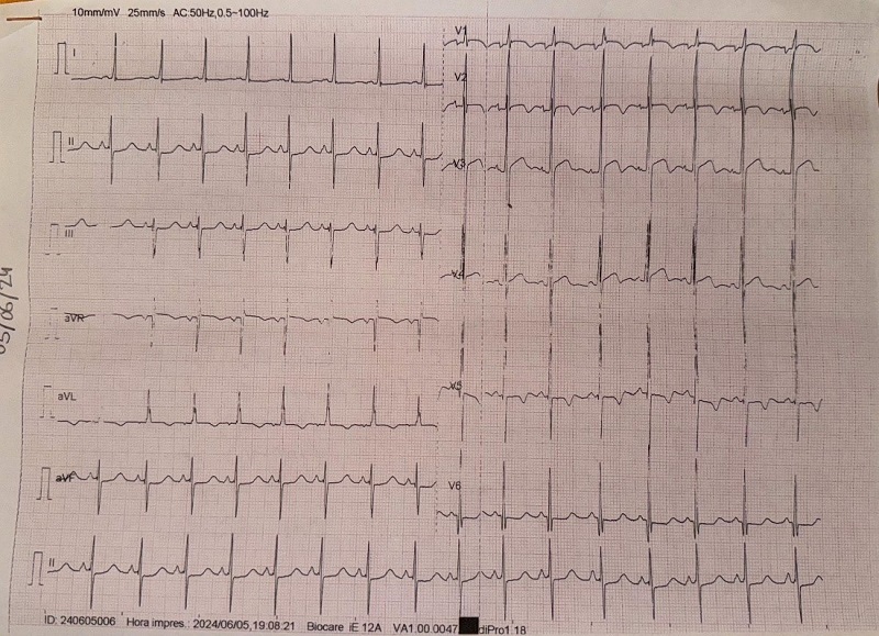 Figura 1. Electrocardiograma del centro de salud con signos de HVI