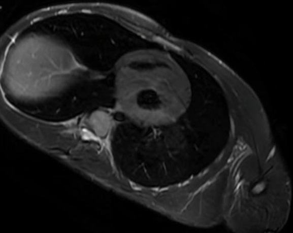 Figura 2. Resonancia magnética que muestra hipertrofia ventricular izquierda con septo de 31 mm