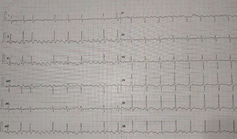Figura 1. Electrocardiograma