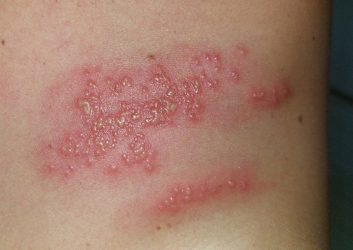 Figura 1. Lesiones vesiculosas
