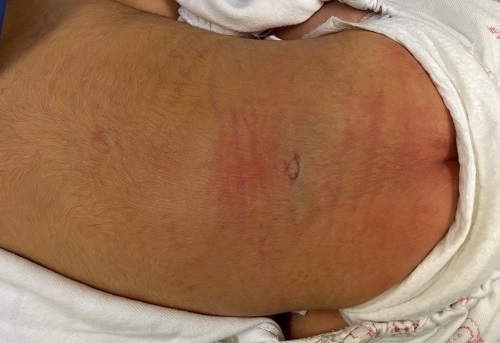 Figura 1. Defecto cutáneo en región lumbosacra, sugestiva de aplasia cutis