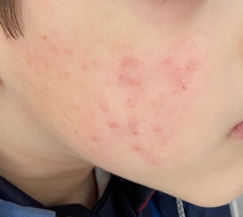 Figura 1. Acrodermatitis de Gianotti-Crosti