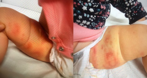 Figura 1. Edema hemorrágico agudo del lactante