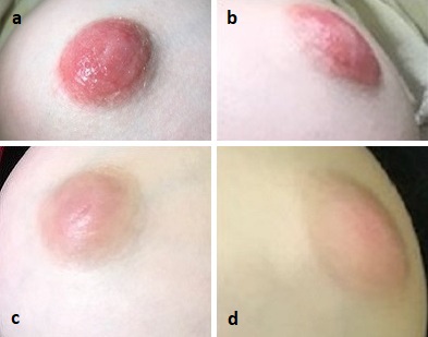 Figura 1. Fotografías de areolas antes y después del tratamiento corticoideo tópico. 