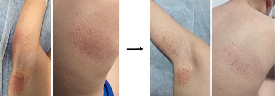 Figura 1. Exantema petequial confluente en axilas y escápula (izquierda). Evolución del mismo exantema a las 48 horas (derecha). 