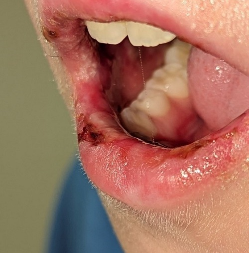 Figura 1. Lesiones ampollosas hemorrágicas a nivel de mucosa oral al inicio de la afectación