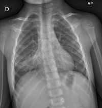 Figura 1. Radiografía de tórax