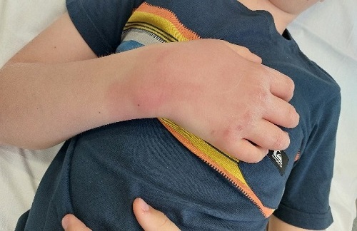 Figura 1. Edema, eritema y calor local en el dorso de la mano irradiado a dedos