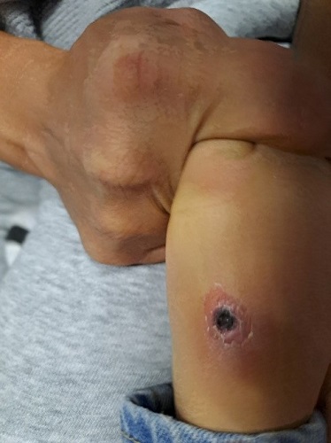 Figura 1. Lesión necrótica ulcerada